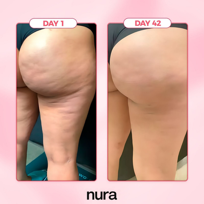 Nura™ - Cellulite Bundle Kit